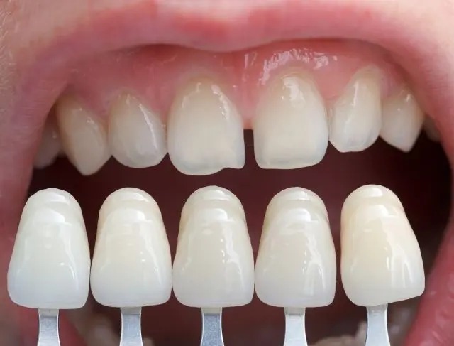 Composite Resin Veneers