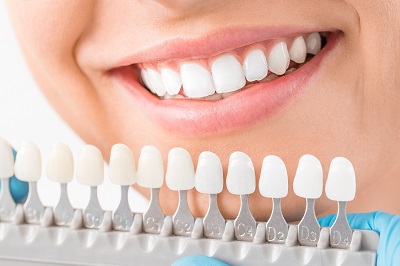 Traditional Veneers Compare