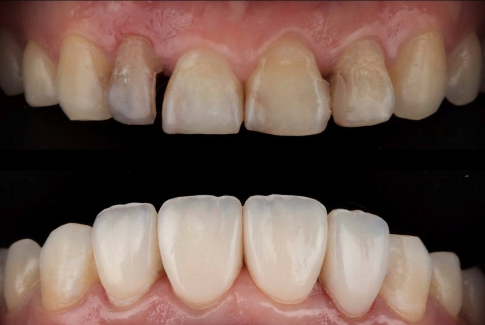 composite veneers